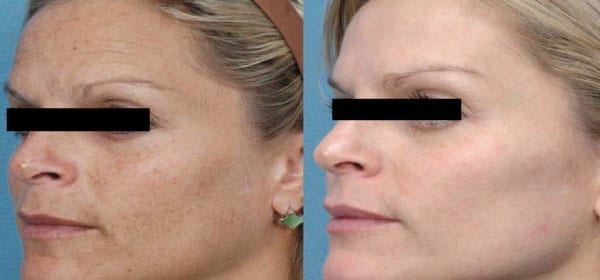 microneedling-ba-02 microneedling-ba-02