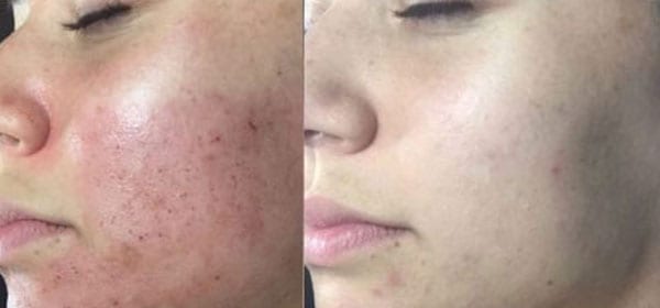 microneedling-ba-03 microneedling-ba-03