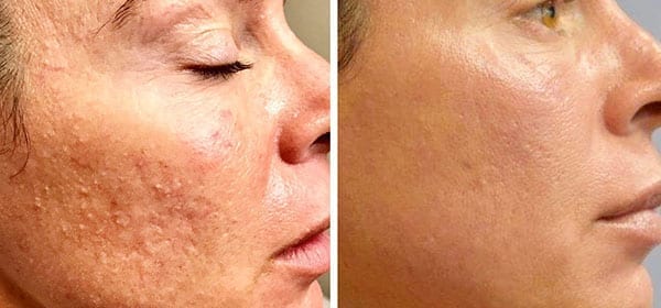 microneedling-ba-05 microneedling-ba-05