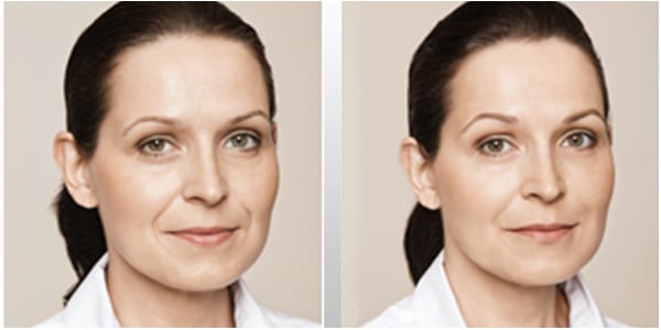 Injectables | 8 Point Lift (W) - Cadella Aesthetics