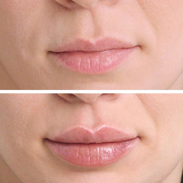 restylane-kysse-1