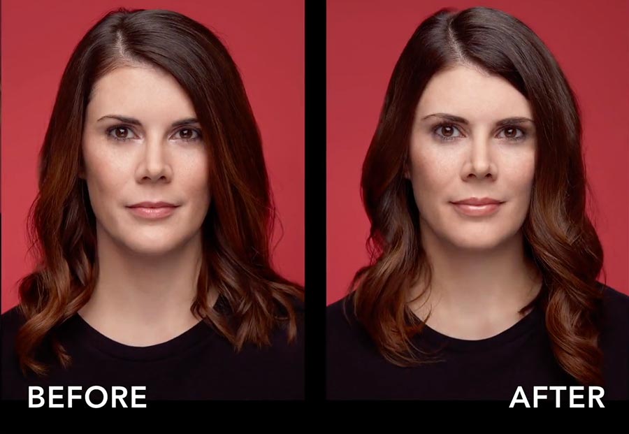 belotero-lips-beforeafter-2