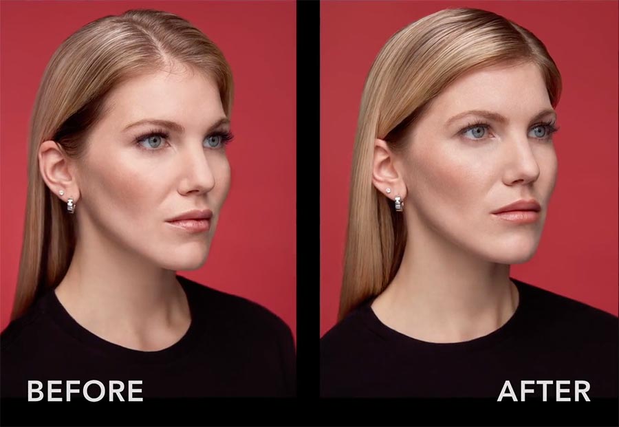 belotero-lips-beforeafter-3