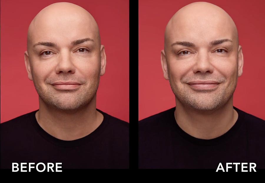 belotero-lips-beforeafter-4